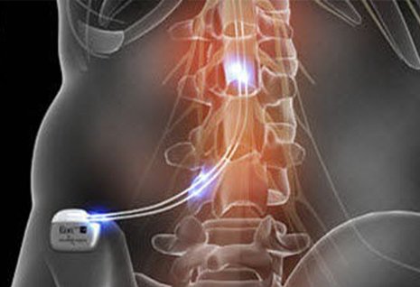 New and Improved Spinal Cord Stimulators Provide Drug-Free Relief From  Chronic Back Pain: Desh Sahni, M.D.: Neurosurgeon